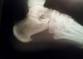 Espolón Calcáneo ó Fascitis Plantar