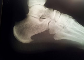 Espolón Calcáneo ó Fascitis Plantar