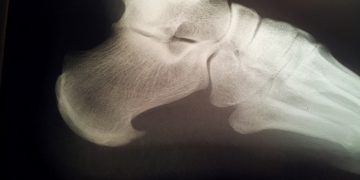 Espolón Calcáneo ó Fascitis Plantar